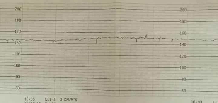 多普勒胎心仪怎么用胎心仪快别买了，没用又伤胎！_https://www.jmylbn.com_新闻资讯_第5张