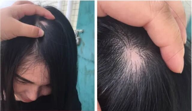 “秃”如其来，斑秃青年的痛苦问题你一定要知道！