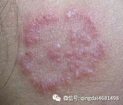 脂溢性皮炎是什么？