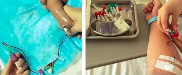 经留置针采血，采集的标本会影响检验结果吗？不看不知道