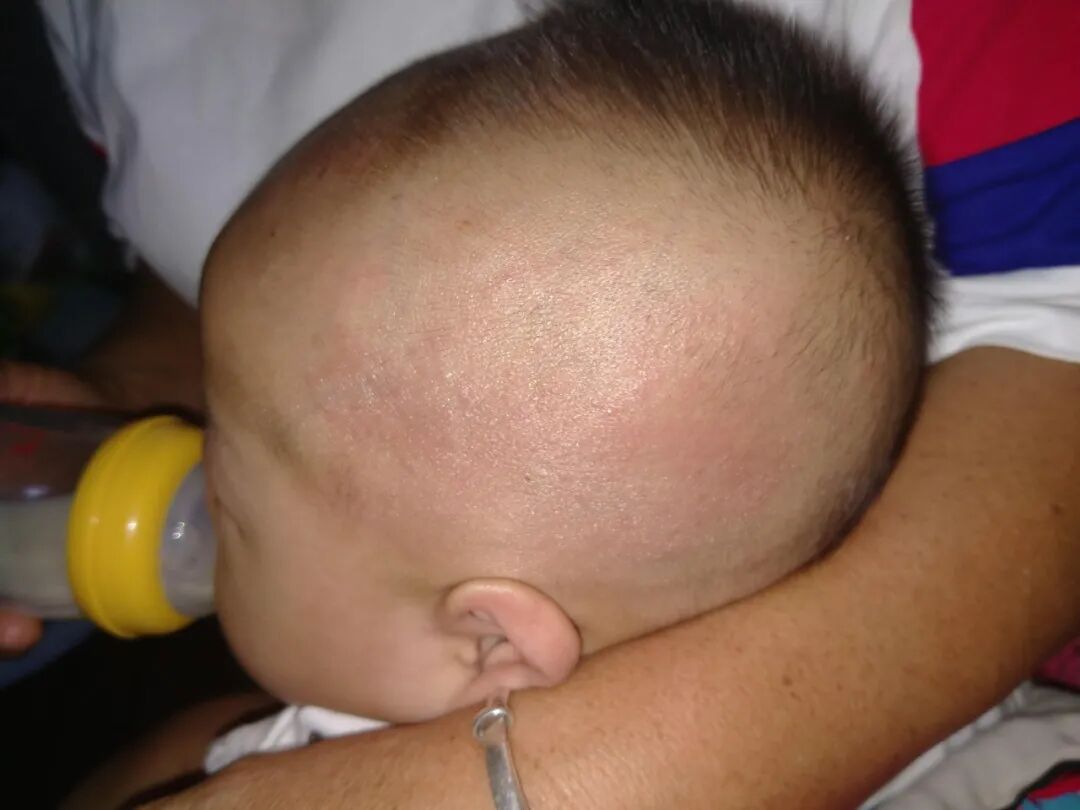 留置针怎么贴膜小儿医用黏胶性损伤和贴膜过敏的案例分析_https://www.jmylbn.com_新闻资讯_第11张