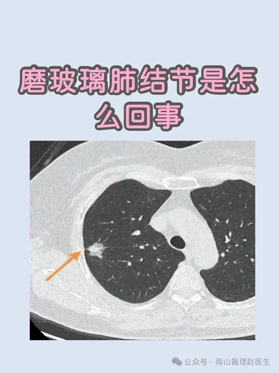 治疗肺磨玻璃结节