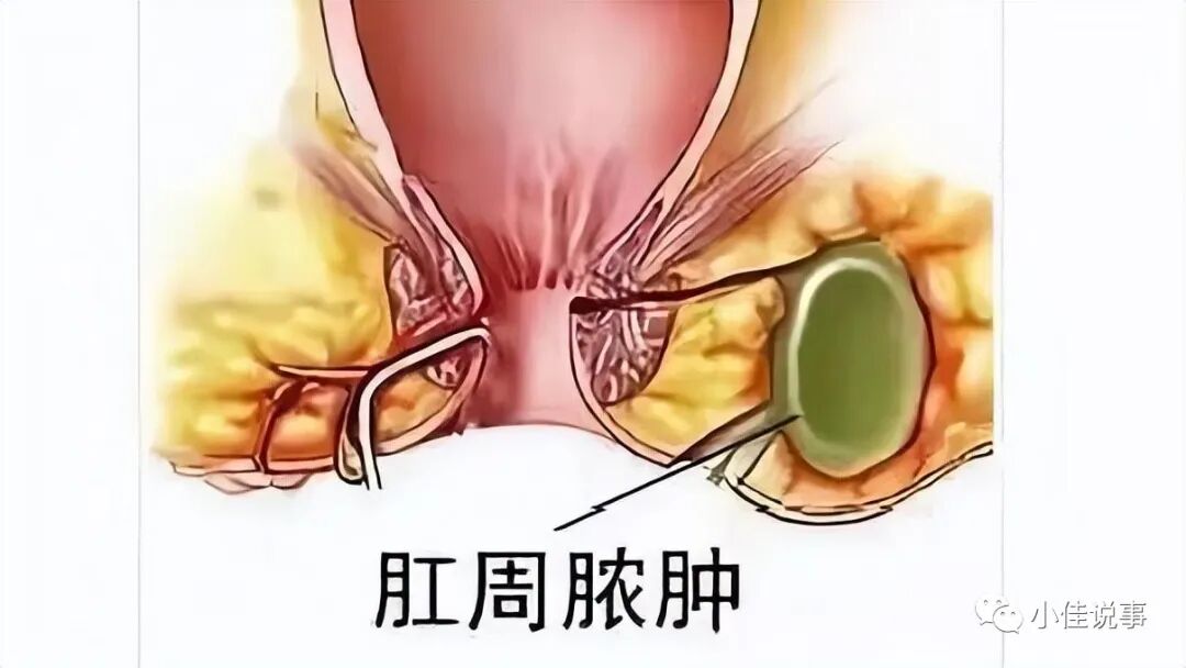 洗肛门怎么洗你有“洗肛门”的习惯吗？洗干净有什么好处？别害羞，看看怎么洗_https://www.jmylbn.com_新闻资讯_第9张