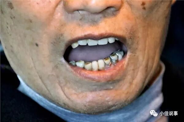 牙不好的人患胰腺癌风险更高？洗牙有什么好处？50岁后的人多看看