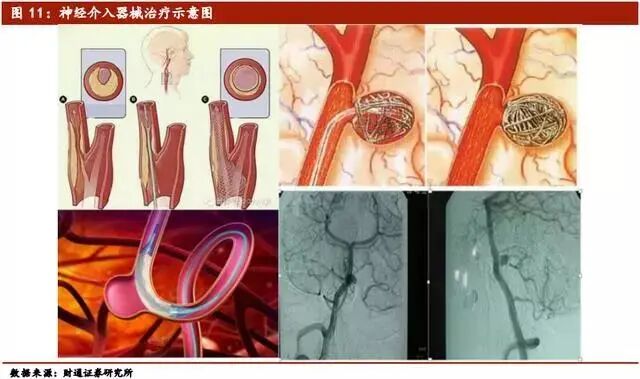 心脏治疗仪器是什么医疗介入器械行业深度报告（下篇）_https://www.jmylbn.com_新闻资讯_第3张