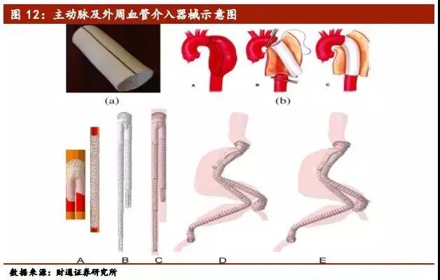 心脏治疗仪器是什么医疗介入器械行业深度报告（下篇）_https://www.jmylbn.com_新闻资讯_第4张