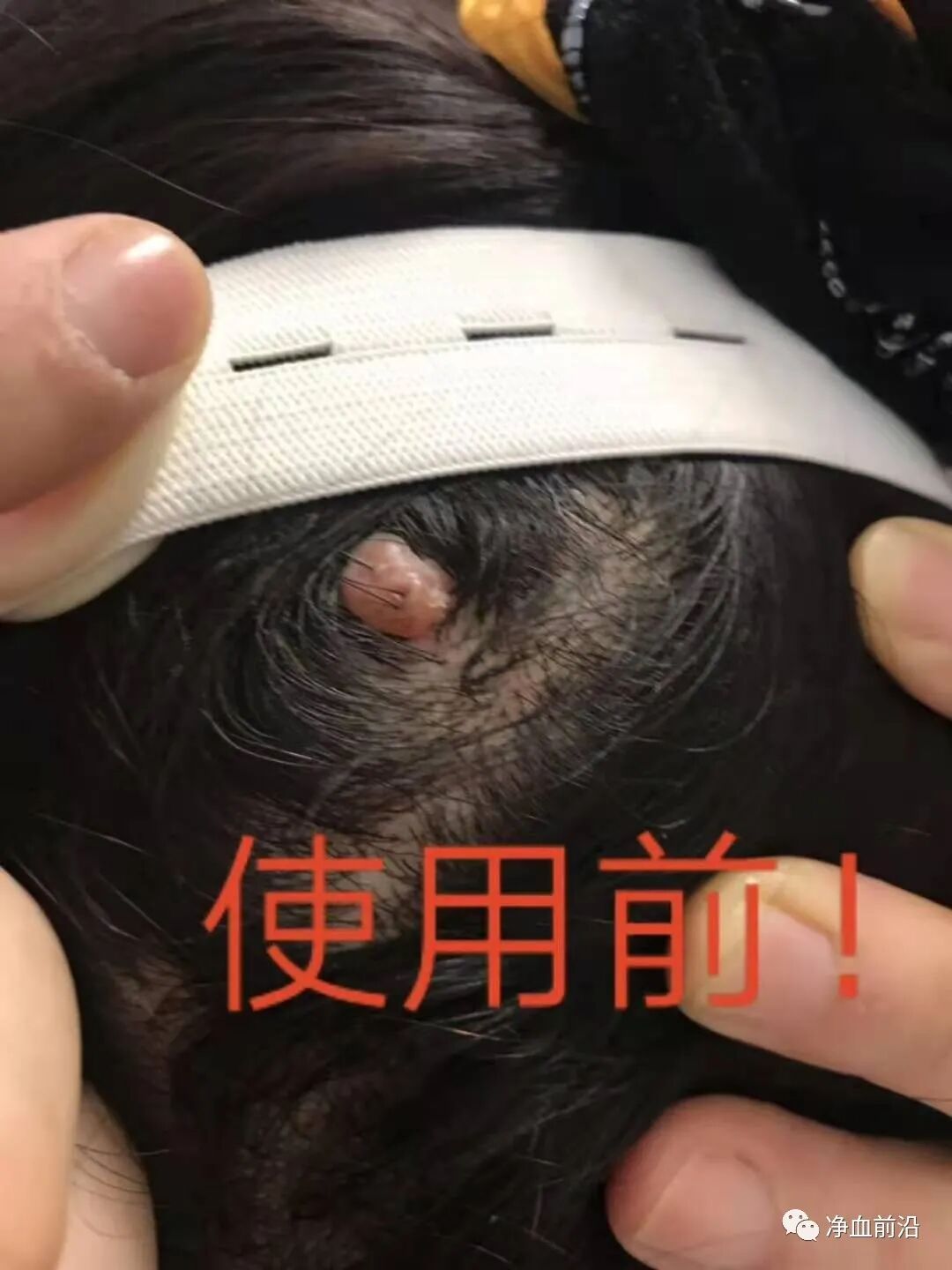 半导体激光治疗仪怎么样半导体激光治疗仪如何使用，什么是基础治疗，外照穴位说明！_https://www.jmylbn.com_新闻资讯_第18张