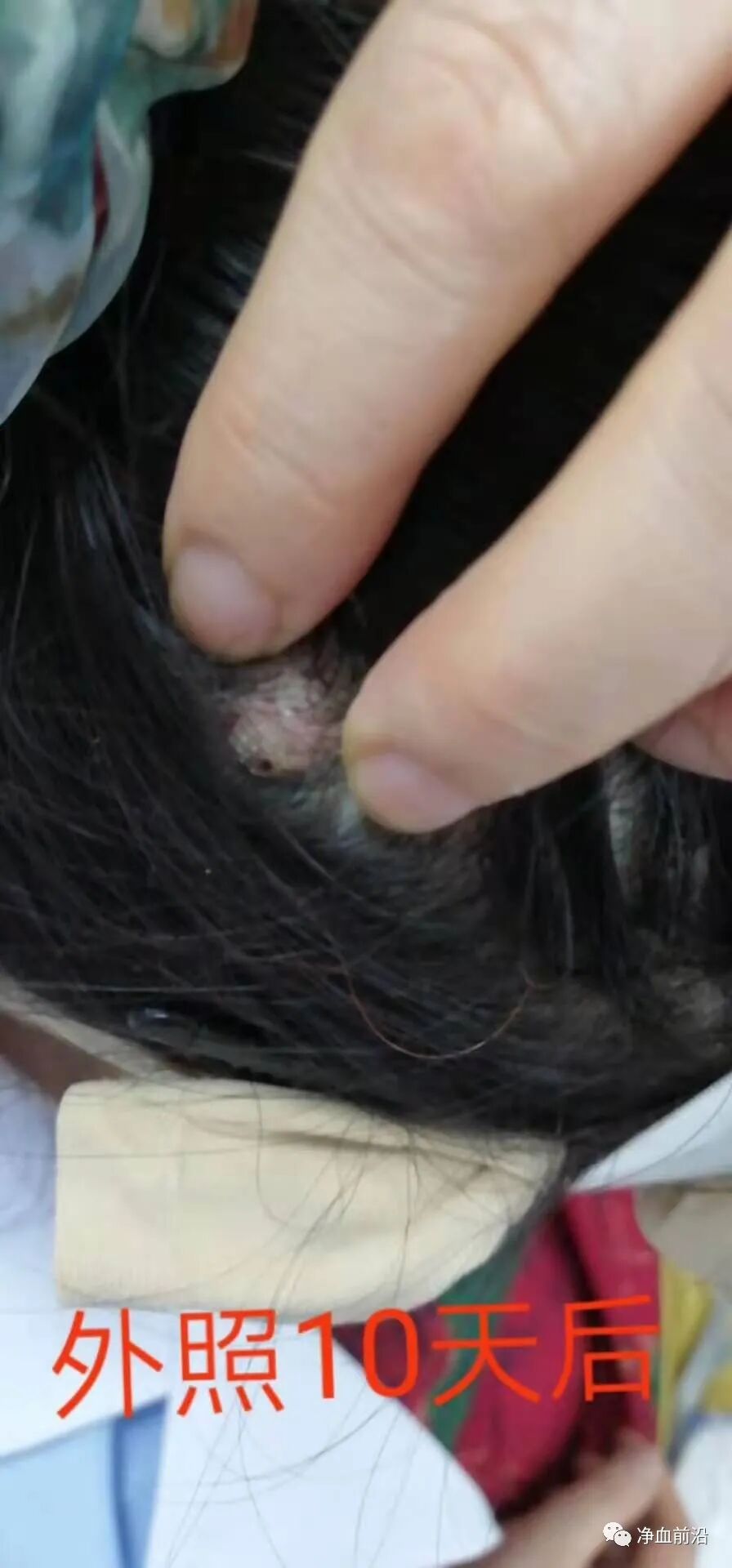 半导体激光治疗仪怎么样半导体激光治疗仪如何使用，什么是基础治疗，外照穴位说明！_https://www.jmylbn.com_新闻资讯_第20张