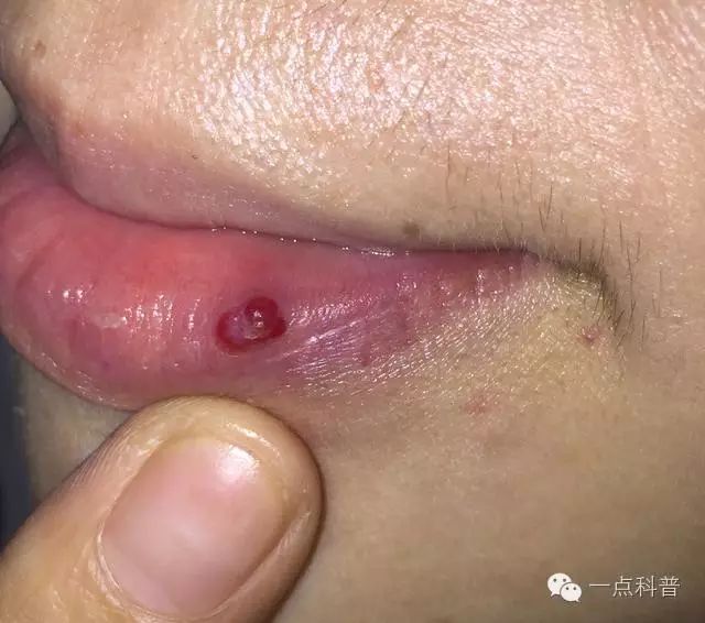 总撕嘴唇干皮出现一个小樱桃破了出血还止不住这是化脓性肉芽肿