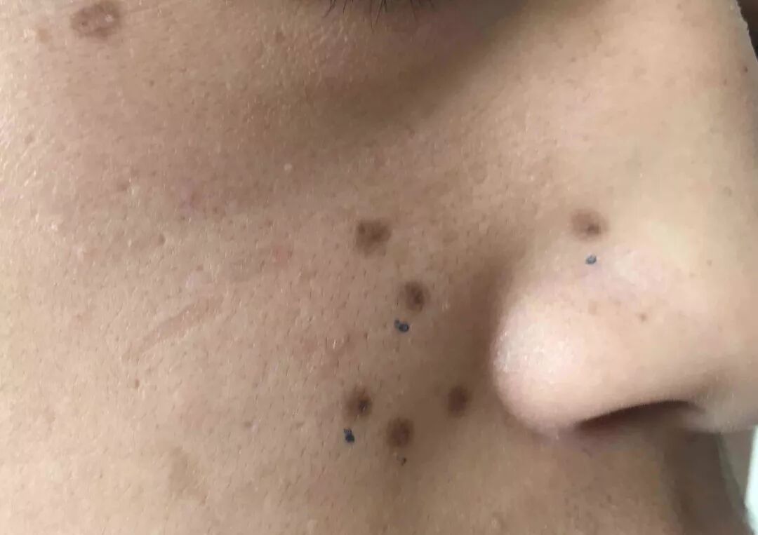 脸上的色素痣怎么办呢 一点科普 微信公众号文章阅读 Wemp