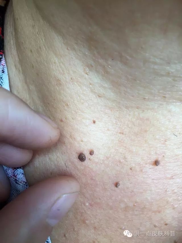 女人怀孕脖子长了很多小瘊子咋回事咋治疗