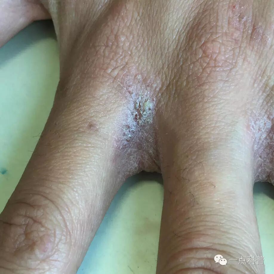 一人得这个病全家都遭殃,特别是晚上痒的睡不着,这就是传说中的疥疮