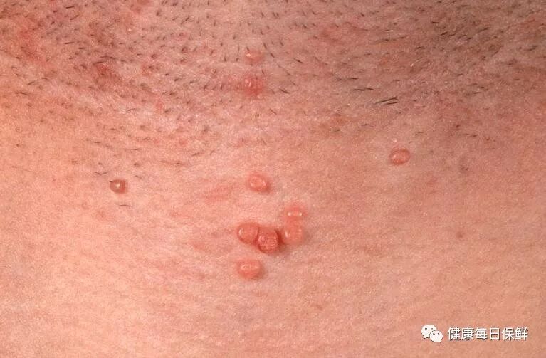 糖尿病、肿瘤、肝肾疾病，皮肤上都有信号，你注意到了么？ - 健康每日 