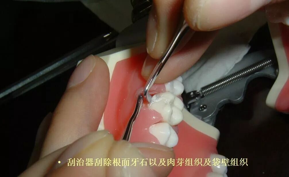牙医必备:松牙固定术