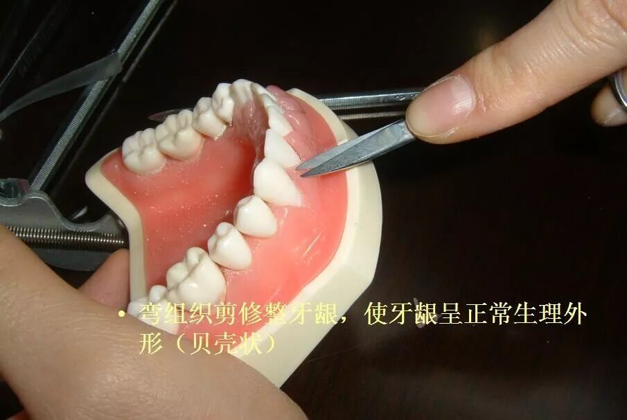 牙医必备:松牙固定术
