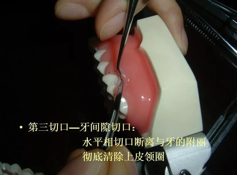 牙弓夹板固定术图解图片