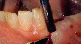 拔牙中吸唾器的使用技巧