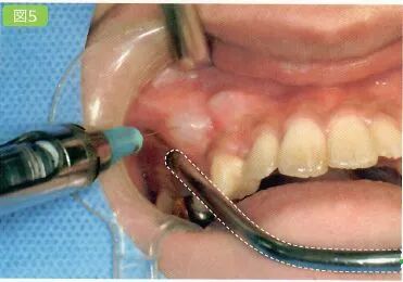 刮匙怎么使用拔牙中吸唾器的使用技巧_https://www.jmylbn.com_新闻资讯_第12张