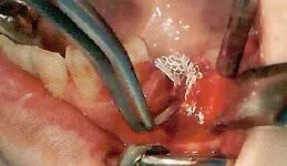 刮匙怎么使用拔牙中吸唾器的使用技巧_https://www.jmylbn.com_新闻资讯_第33张