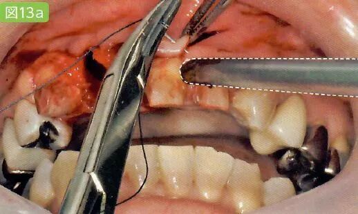 拔牙中吸唾器的使用技巧