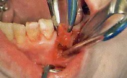 刮匙怎么使用拔牙中吸唾器的使用技巧_https://www.jmylbn.com_新闻资讯_第26张