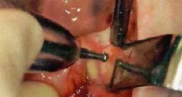 拔牙中吸唾器的使用技巧