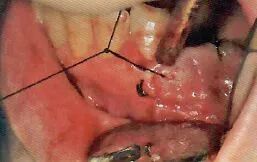 拔牙中吸唾器的使用技巧