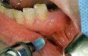 拔牙中吸唾器的使用技巧