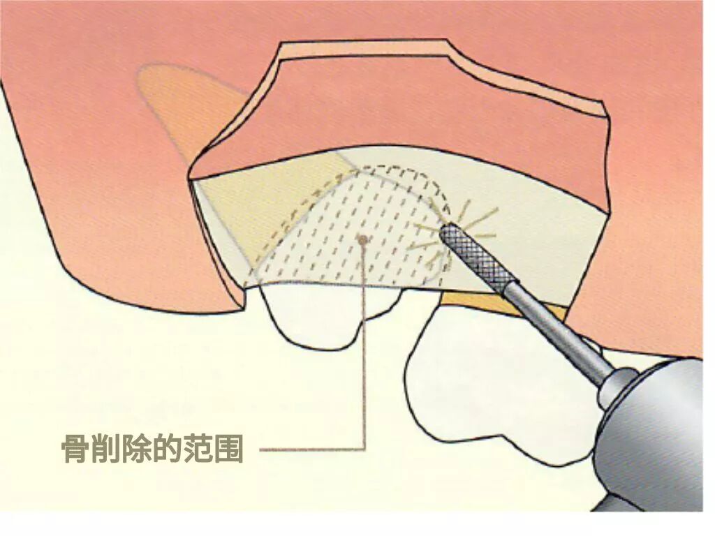 拔牙中吸唾器的使用技巧