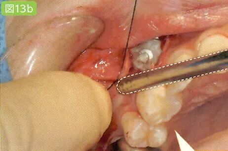 拔牙中吸唾器的使用技巧