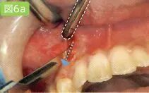 刮匙怎么使用拔牙中吸唾器的使用技巧_https://www.jmylbn.com_新闻资讯_第15张