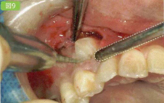 刮匙怎么使用拔牙中吸唾器的使用技巧_https://www.jmylbn.com_新闻资讯_第23张