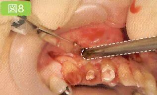 刮匙怎么使用拔牙中吸唾器的使用技巧_https://www.jmylbn.com_新闻资讯_第19张