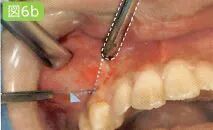 刮匙怎么使用拔牙中吸唾器的使用技巧_https://www.jmylbn.com_新闻资讯_第16张