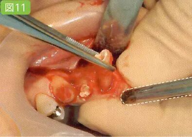 拔牙中吸唾器的使用技巧