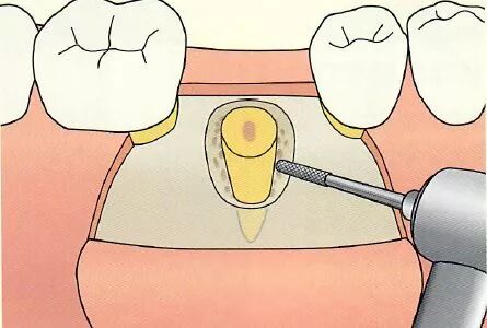 刮匙怎么使用拔牙中吸唾器的使用技巧_https://www.jmylbn.com_新闻资讯_第22张