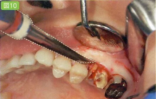 拔牙中吸唾器的使用技巧