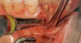 刮匙怎么使用拔牙中吸唾器的使用技巧_https://www.jmylbn.com_新闻资讯_第24张