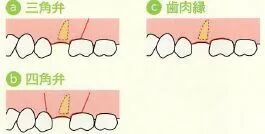 刮匙怎么使用拔牙中吸唾器的使用技巧_https://www.jmylbn.com_新闻资讯_第14张