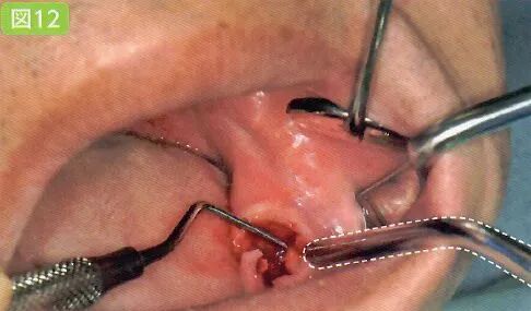 刮匙怎么使用拔牙中吸唾器的使用技巧_https://www.jmylbn.com_新闻资讯_第29张