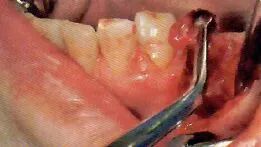 拔牙中吸唾器的使用技巧