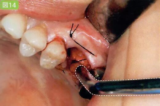 刮匙怎么使用拔牙中吸唾器的使用技巧_https://www.jmylbn.com_新闻资讯_第34张
