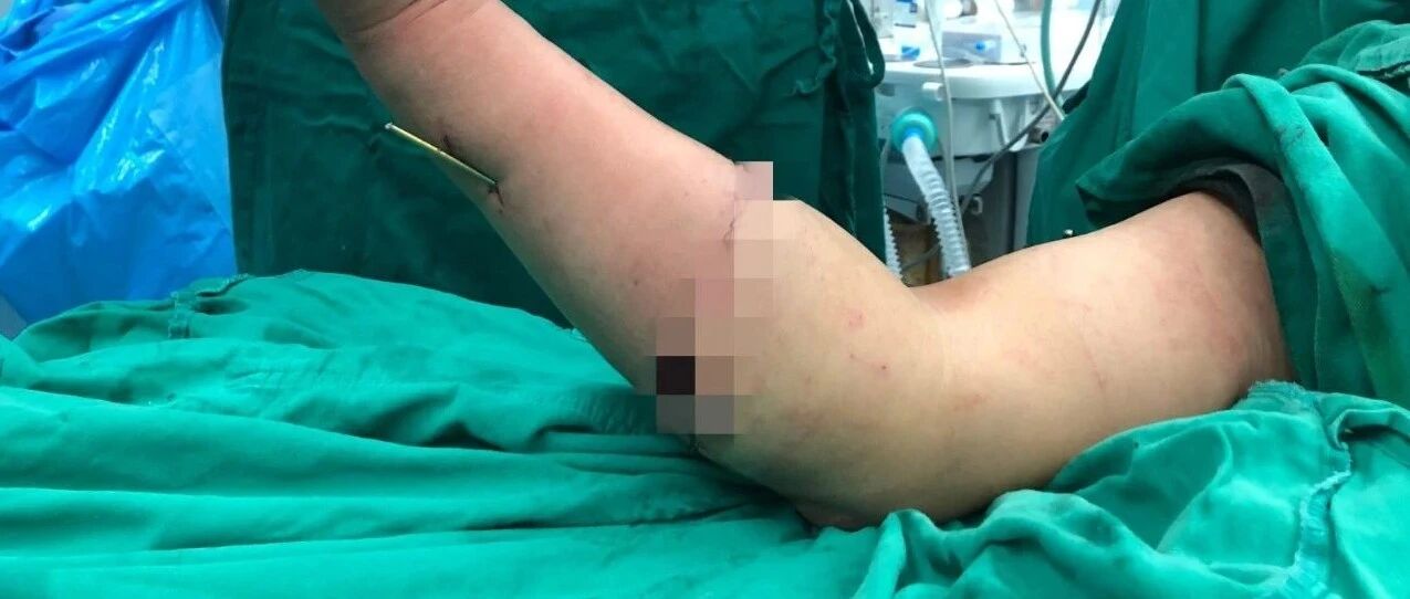 定安一男子遭人持割草机断臂！骨头、神经血管均完全断裂…
