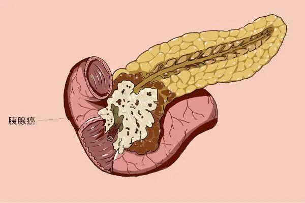 男子得胰腺癌浑然不觉，以为是胃病，胰腺病变的3个信号，早了解