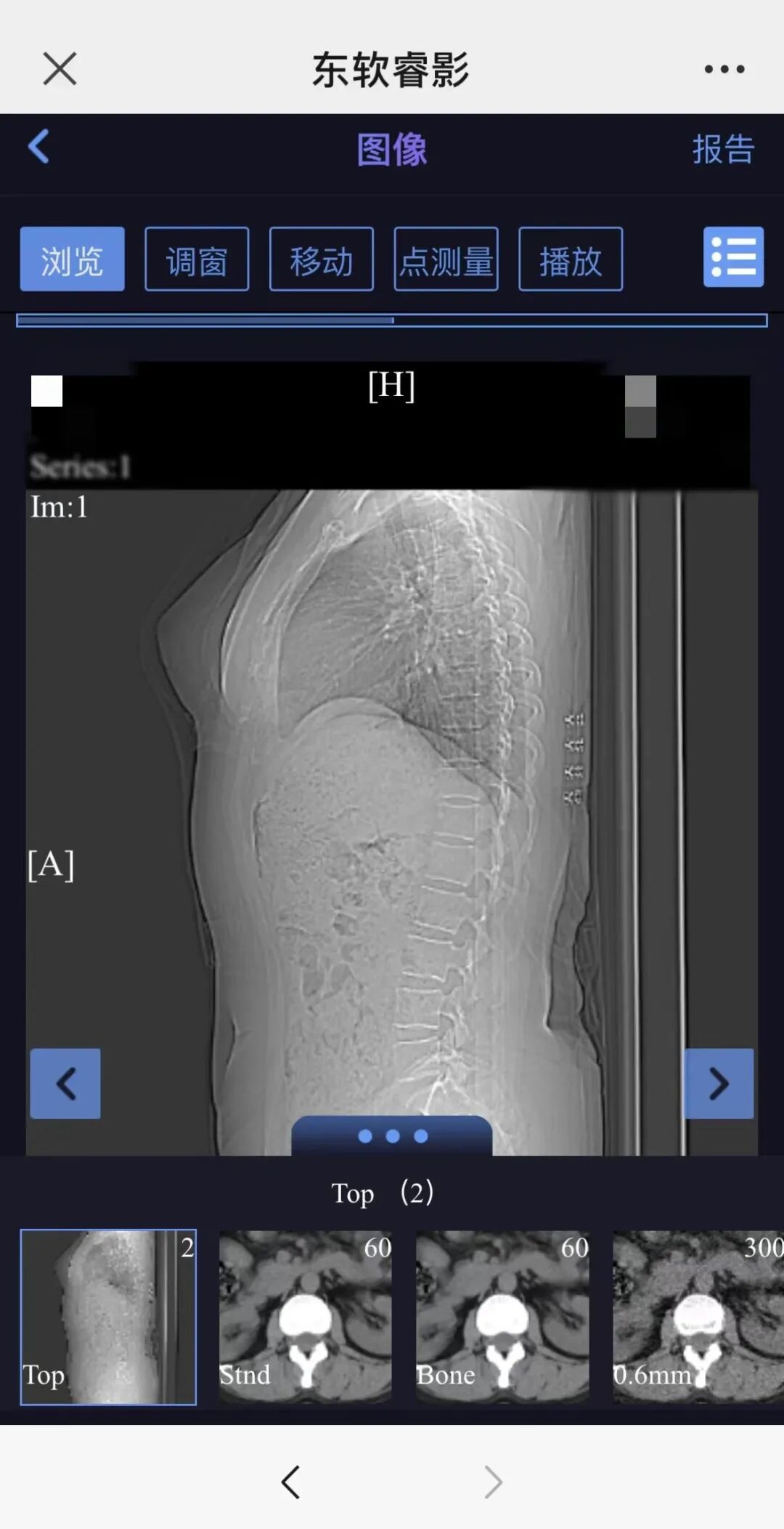 dr胶片怎么看四抓在行动丨“云胶片”服务来啦，CT／DR／MR数字影像和报告手机上就能看！_https://www.jmylbn.com_新闻资讯_第9张