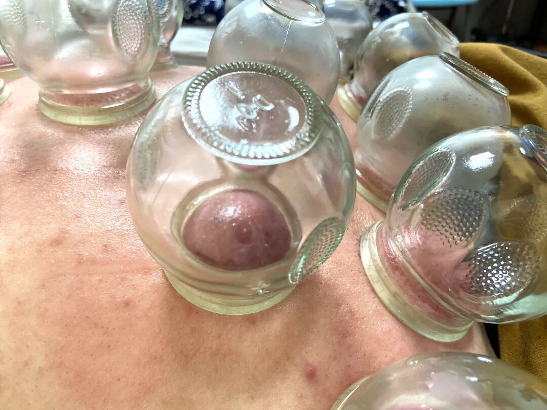 竹火罐怎么用小竹罐，大作用！头部、肩颈、关节都能拔罐！_https://www.jmylbn.com_新闻资讯_第3张