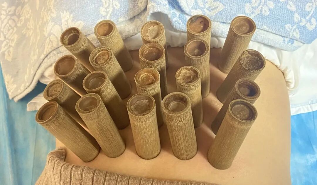 竹火罐怎么用小竹罐，大作用！头部、肩颈、关节都能拔罐！_https://www.jmylbn.com_新闻资讯_第5张