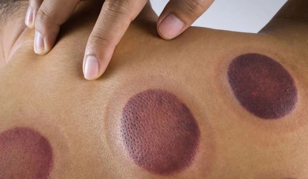 竹火罐怎么用小竹罐，大作用！头部、肩颈、关节都能拔罐！_https://www.jmylbn.com_新闻资讯_第9张