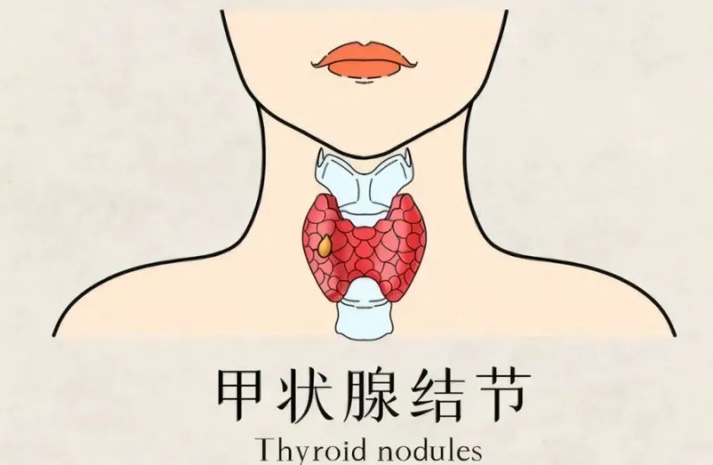 脖子上長包醫生提醒可能是長了甲狀腺結節小心癌變