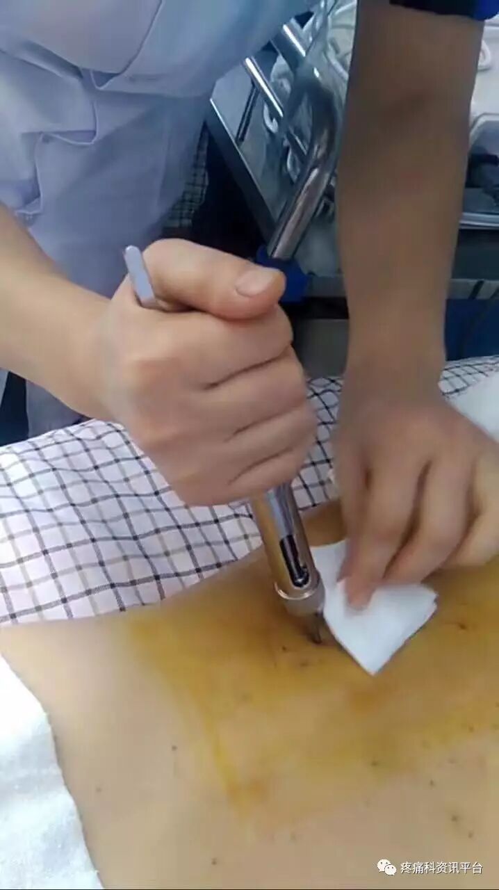 针仪什么意思是什么内热式针灸治疗仪（内热仪）治疗原理_https://www.jmylbn.com_新闻资讯_第6张